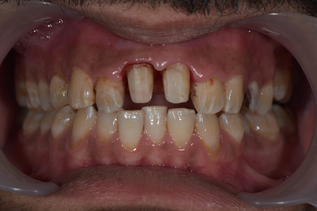 Before